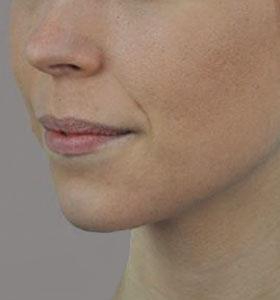 After — Acne Treatment