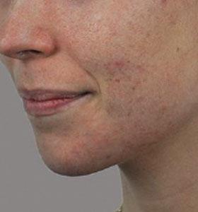 Before — Acne Treatment