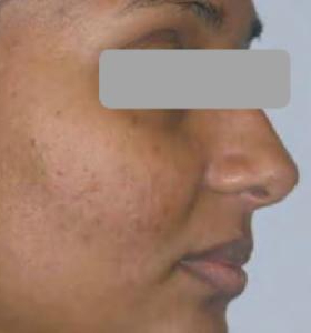 After — Carbon Facial