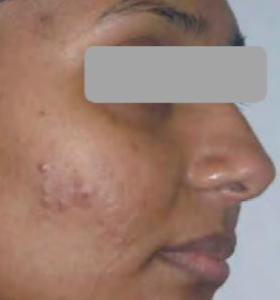 Before — Carbon Facial