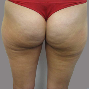 After — Cellulite Reduction