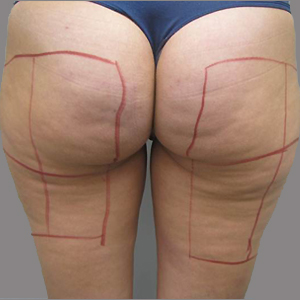 Before — Cellulite Reduction