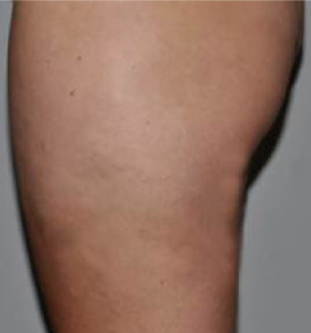 After — Body Tightening