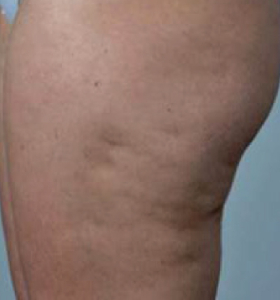 Before — Body Tightening