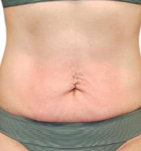 After — Body Contouring