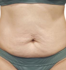 Before — Body Contouring