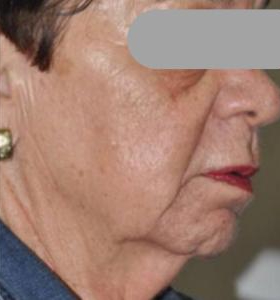 Before — Facial Contouring