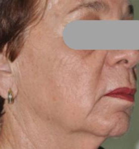 After — Facial Contouring