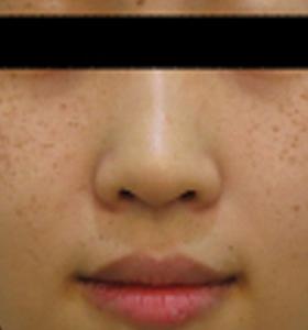 Before — Pigmented lesions