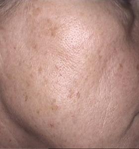 Before — Pigmented lesions
