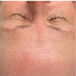 After — Pigmented Lesions