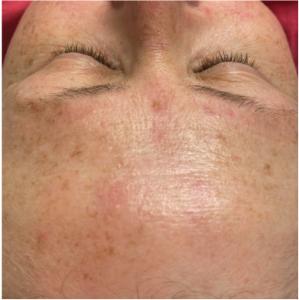 Before — Pigmented Lesions