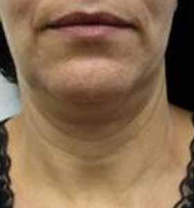 After — Skin tightening