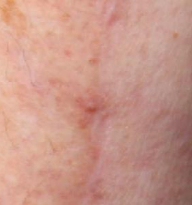 Before — Skin resurfacing
