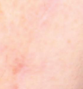 After — Skin resurfacing