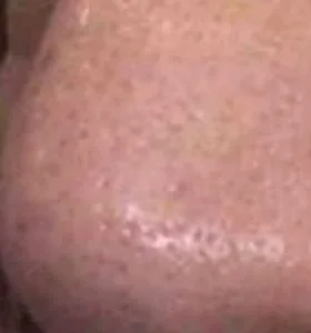 After — Skin rejuvenation