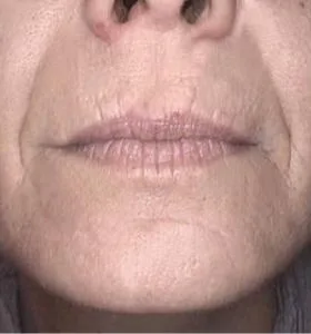 After — Skin rejuvenation
