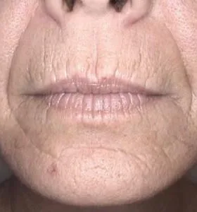 Before — Skin rejuvenation