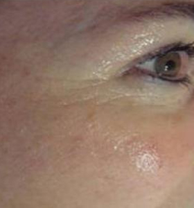 After — Wrinkle reduction