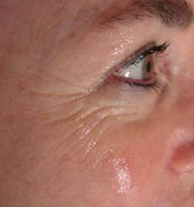Before — Wrinkle reduction
