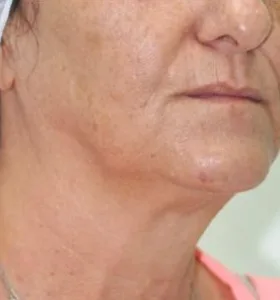 After — Skin rejuvenation