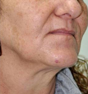 Before — Wrinkle reduction