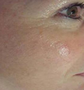 After — Facial Tightening