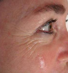 Before — Facial Tightening