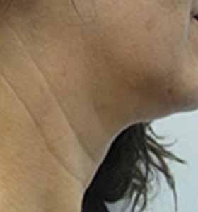 After — Skin tightening