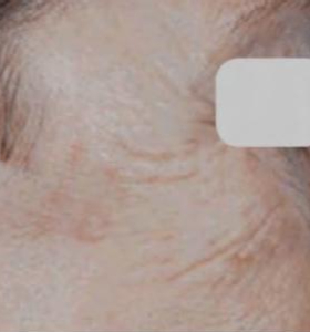 After — Wrinkle reduction