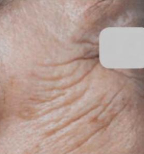 Before — Wrinkle reduction