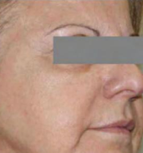 After — Wrinkle reduction