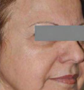 Before — Wrinkle reduction