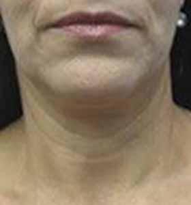 Before — Skin tightening