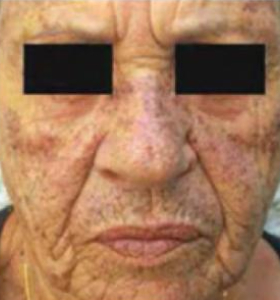 Before — Skin tightening