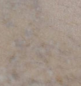 After — Tattoo Removal