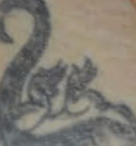 Before — Tattoo Removal