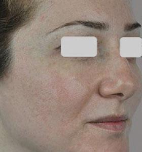 After — Vascular Lesions