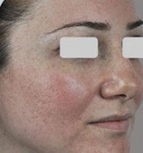 Before — Vascular Lesions