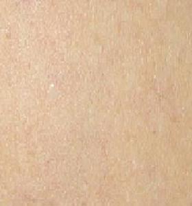 After — Vein Removal